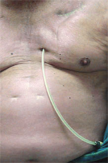 Catheter in abdomen