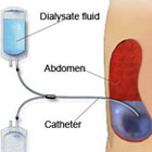 Peritoneal Dialysis