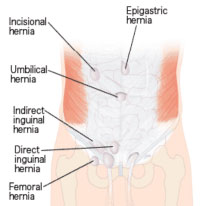 Hernia Recovery Chart