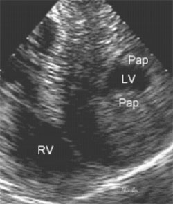 test heart echo 1 Home Common Heading Heart Dialysis a Central Off LVH: test heart echo 1 Home Common Heading Heart Dialysis a Central Off LVH: