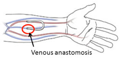 Forearm Loop Graft