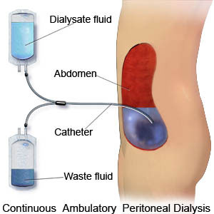 peritoneal dialysis